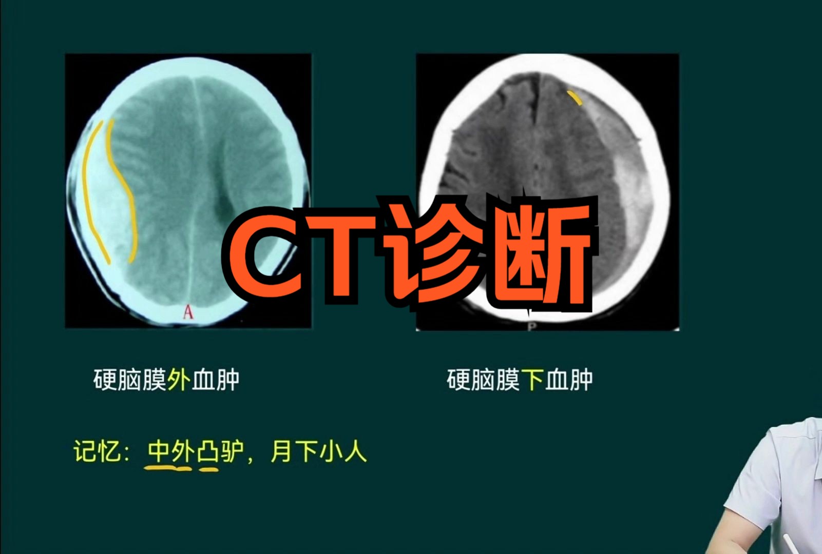 头颅CT急性硬脑膜外血肿和硬脑膜下血肿,记忆方法哔哩哔哩bilibili