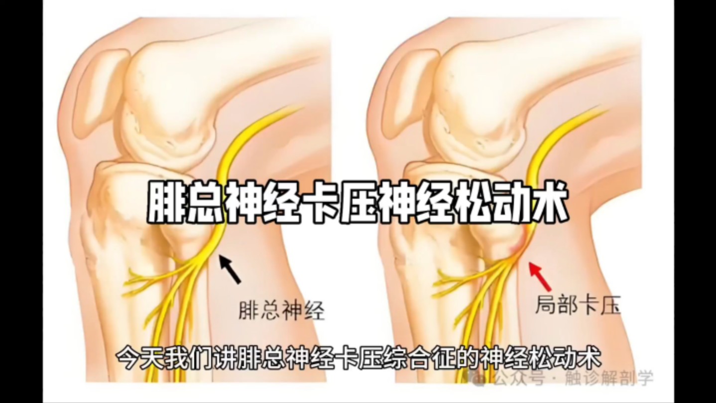 腓总神经神经走行图图片