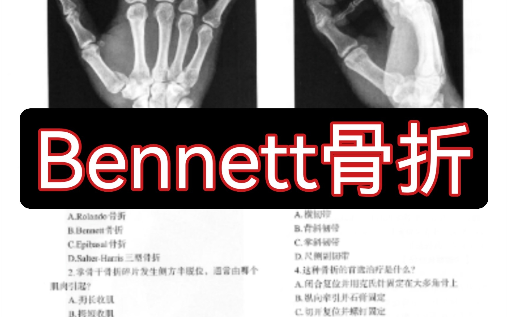 【医学影像】跟我一起刷专著 | Bennett骨折哔哩哔哩bilibili