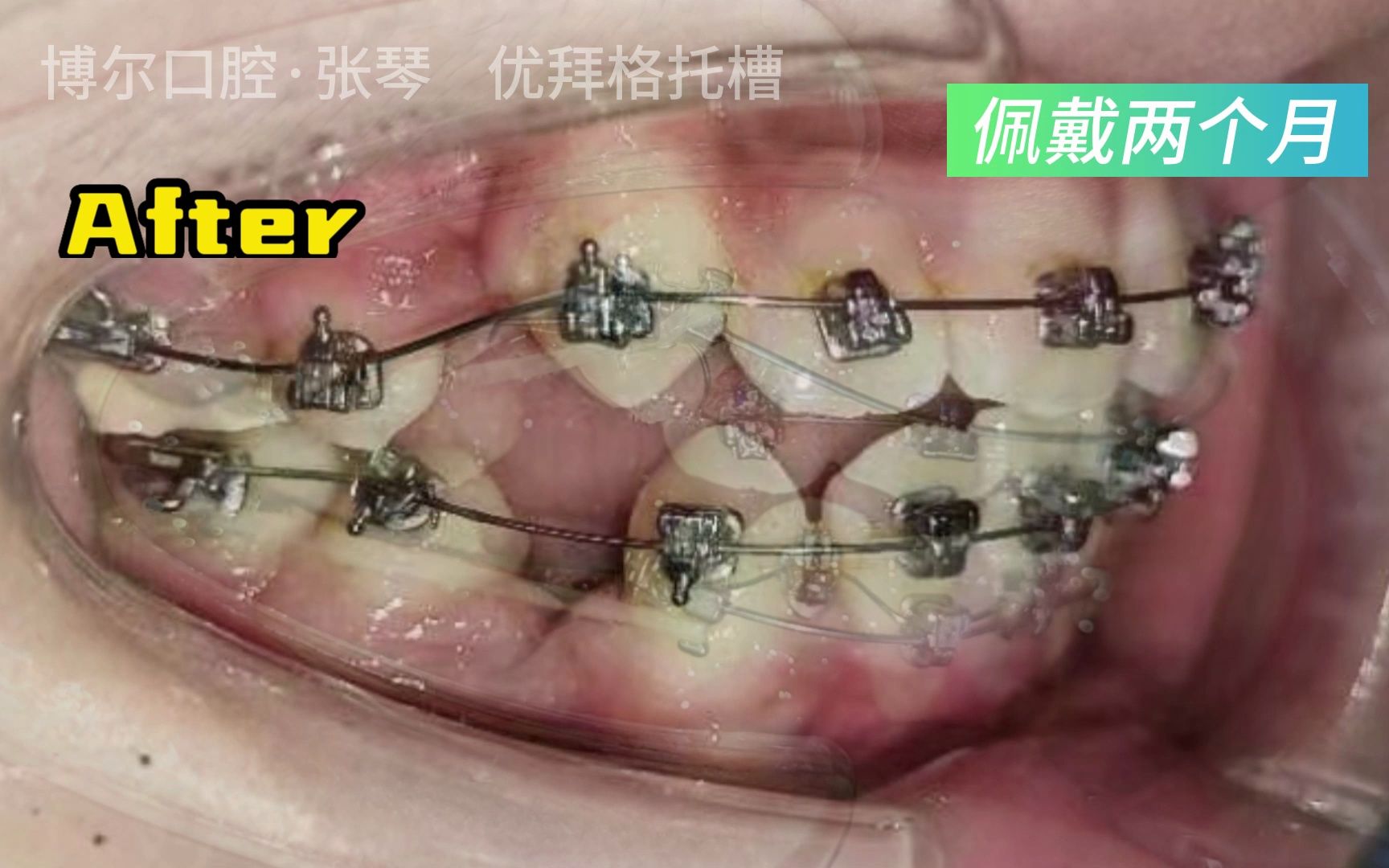 牙齿拥挤佩戴矫正托槽两个月(使用优拜格托槽)哔哩哔哩bilibili