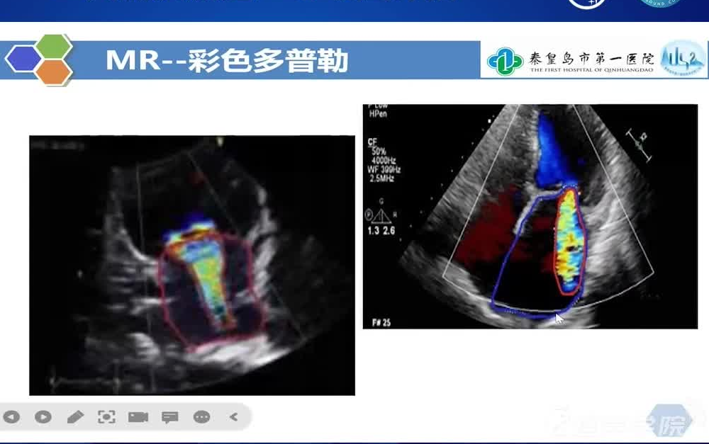 [图]【飞声视界】第141期 二尖瓣反流超声心动图评估.张芳 教授