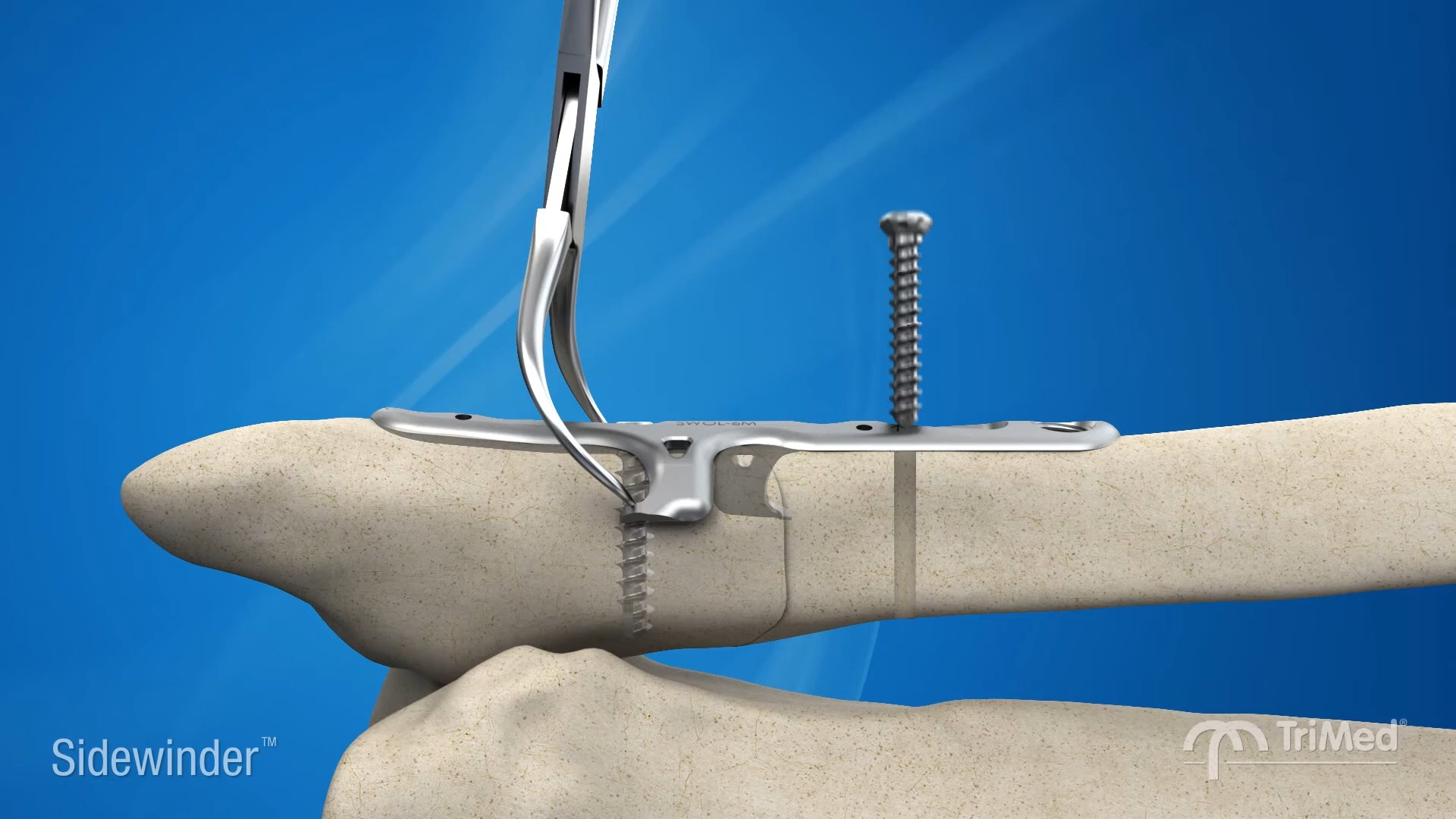 TriMed's Sidewinder is used to treat Weber B, short oblique fibula fractures wit哔哩哔哩bilibili