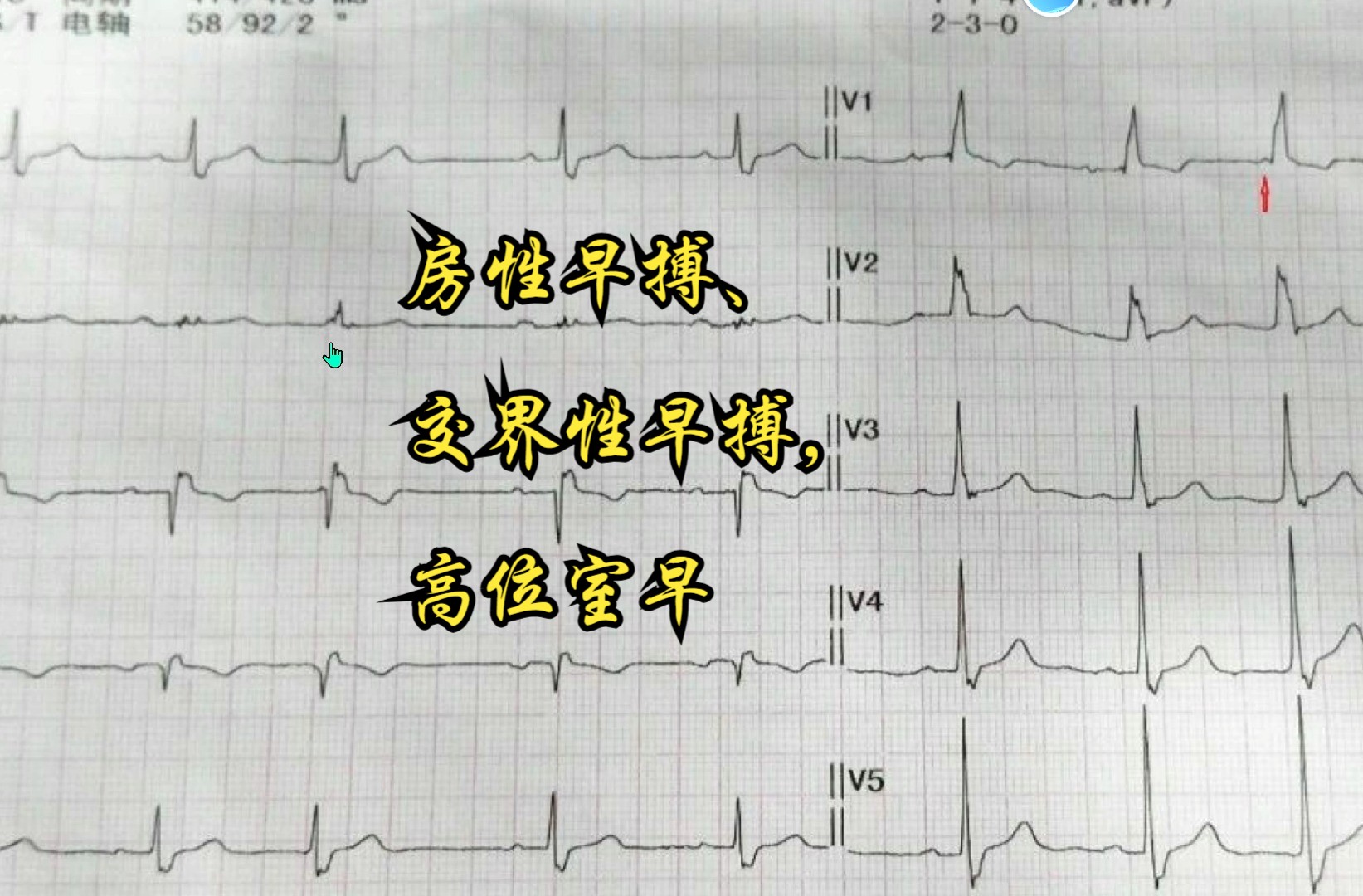 房性早搏、交界性早搏,高位室早哔哩哔哩bilibili