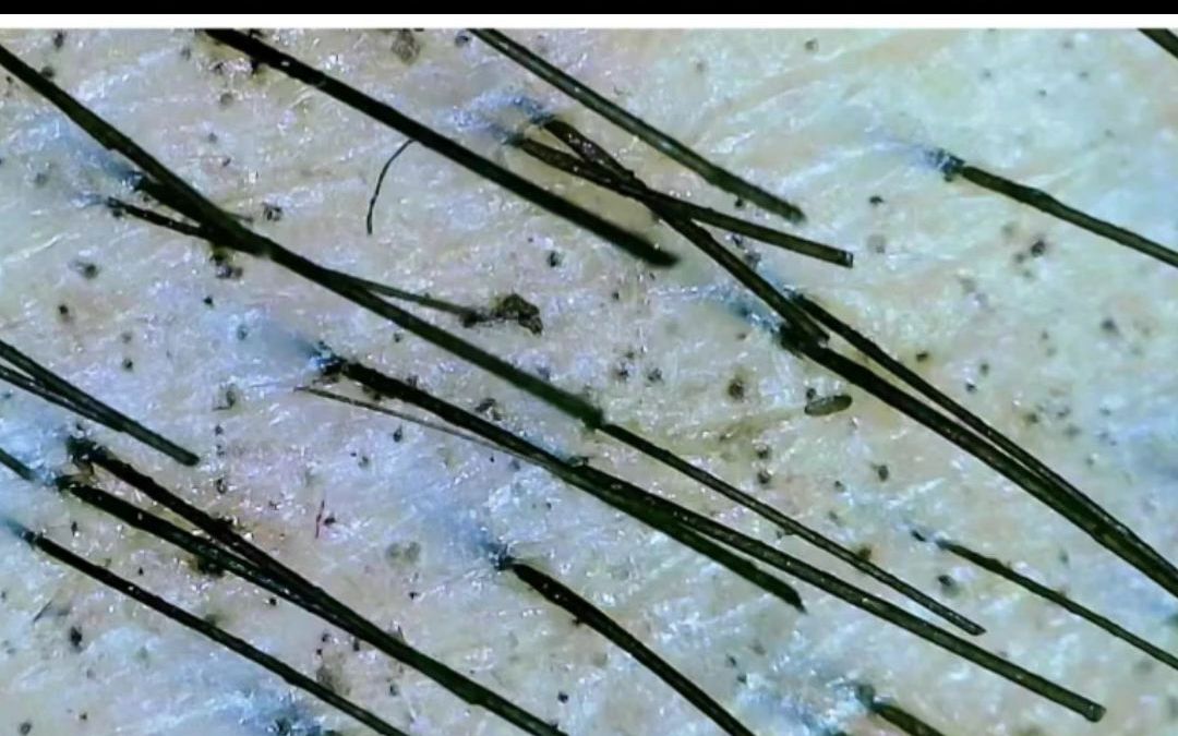 头发稀少,毛囊闭合,毛囊还能复苏吗