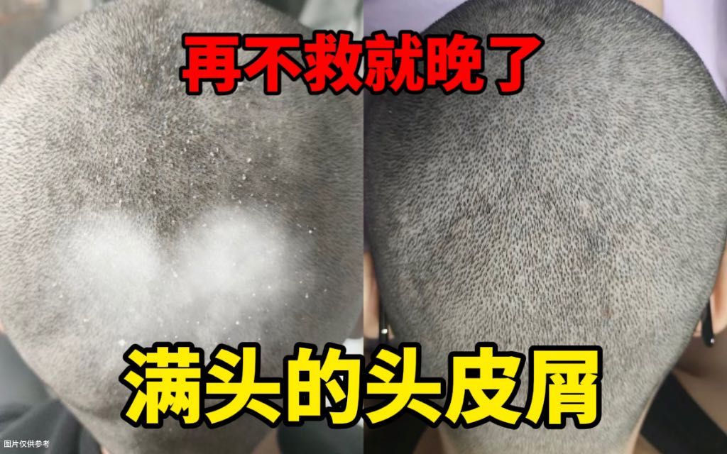 头皮屑多如雪?溢脂性皮炎?再不救就晚了!这款洗发水就可以帮你解决!哔哩哔哩bilibili