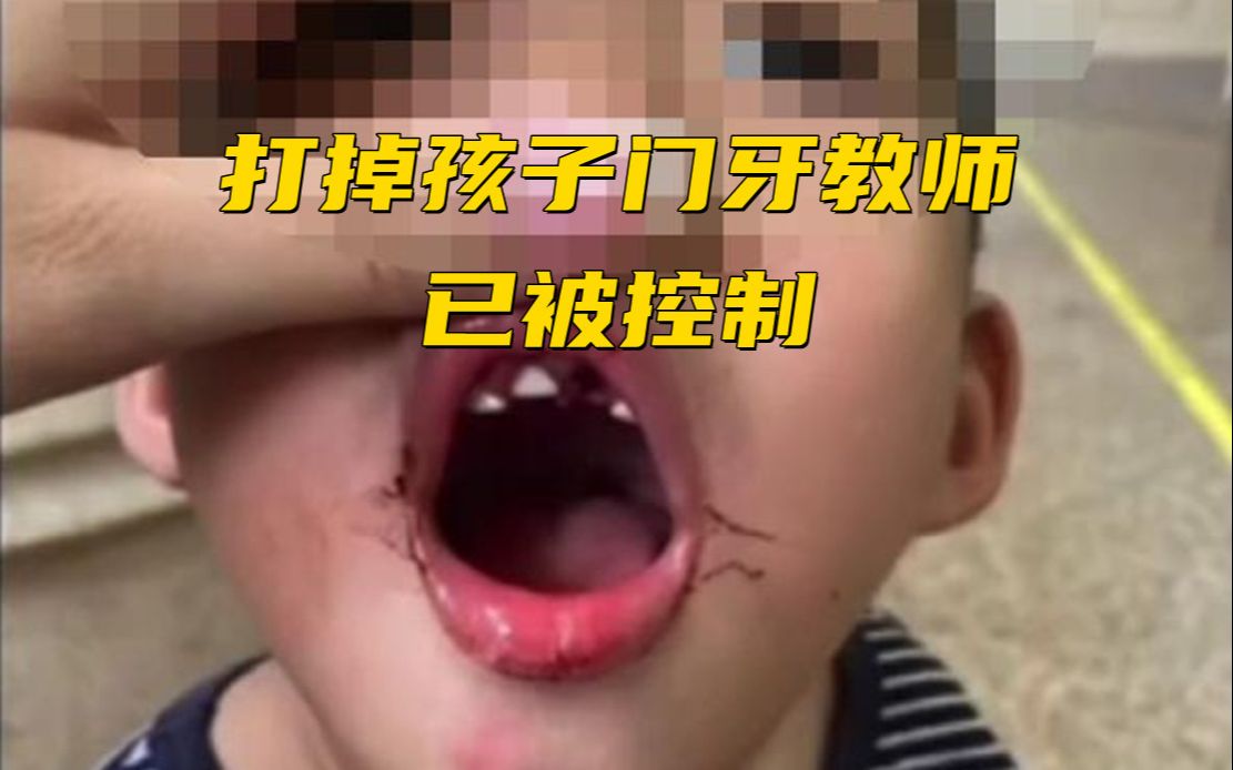 画面揪心!打掉孩子门牙教师已被控制 幼儿园已关停哔哩哔哩bilibili