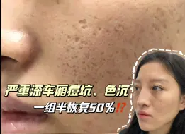 Tải video: 美女严重深车厢痘坑，色沉，一组半坑平了50%！？怎么做到的？