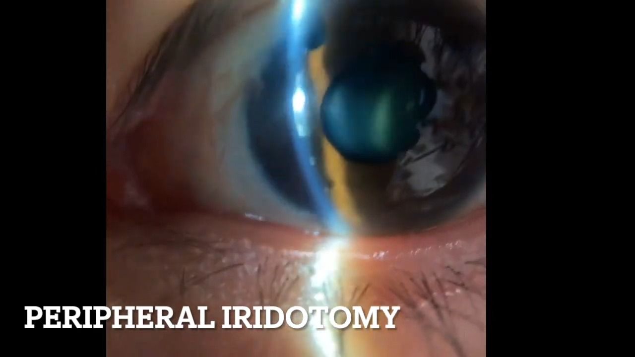 Peripheral Iridotomy  周边虹膜切开术哔哩哔哩bilibili