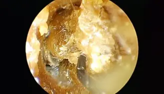 一辈子没掏过耳朵、好多耳屎把耳道堵的严严实实