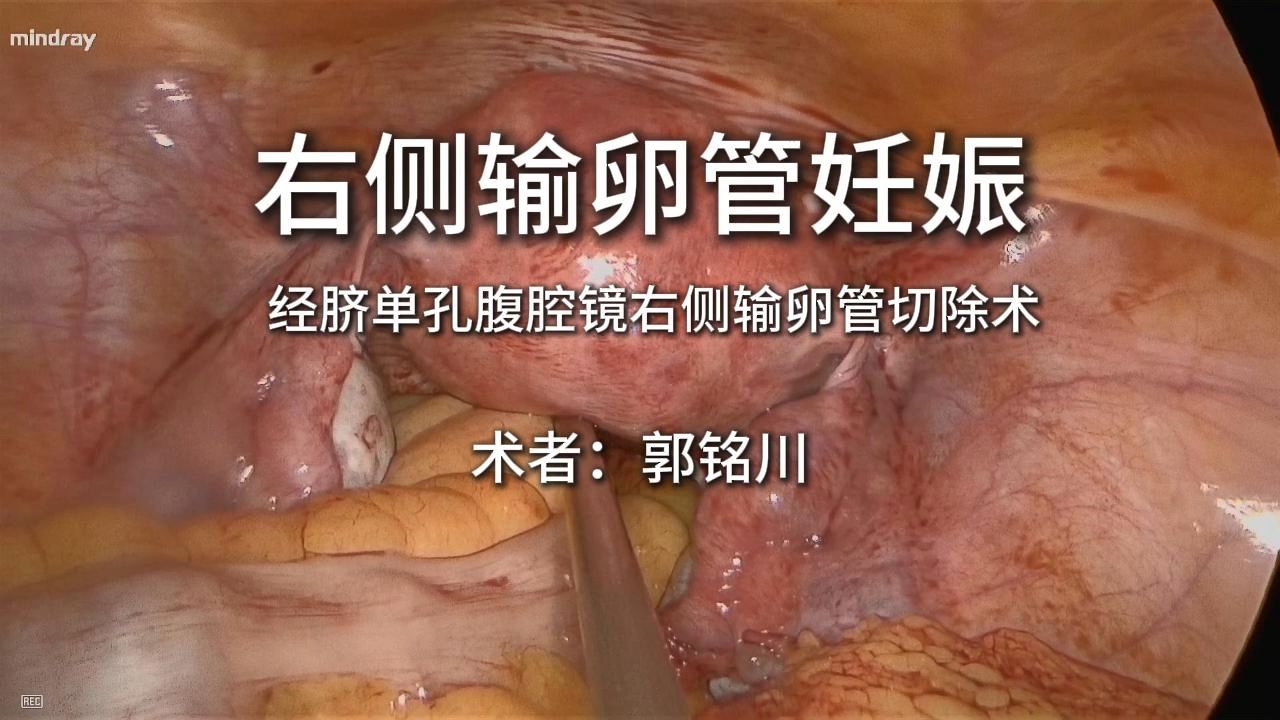 经脐单孔腹腔镜输卵管妊娠切除术哔哩哔哩bilibili