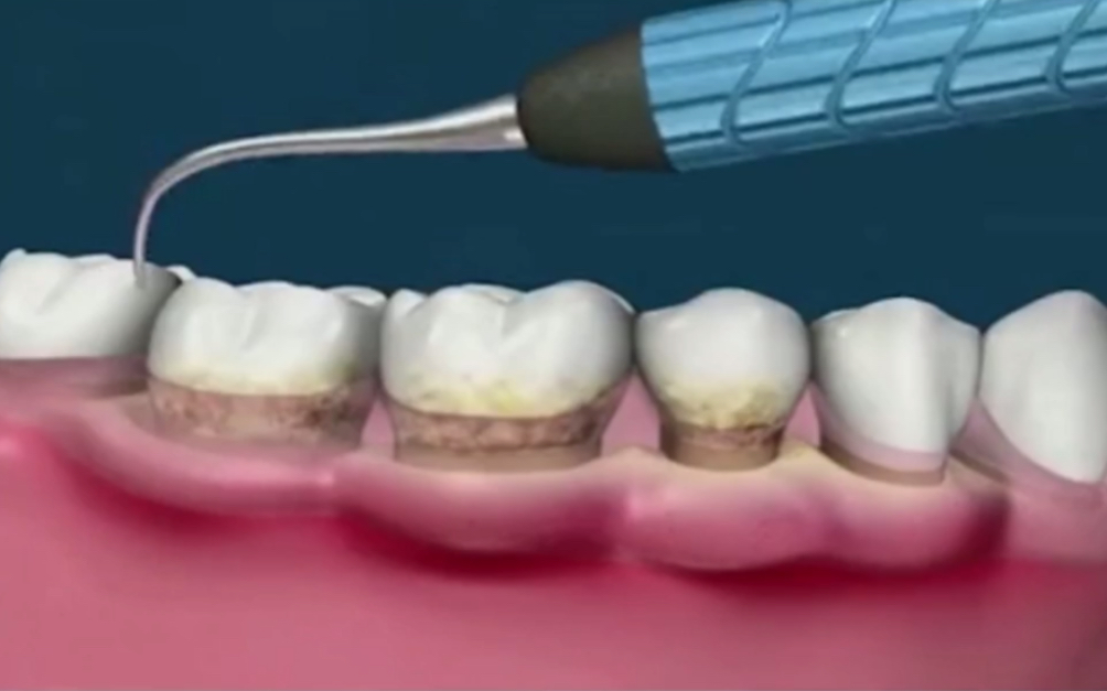 【深圳牙科洗牙科普】舒适龈下洁牙您了解吗?哔哩哔哩bilibili