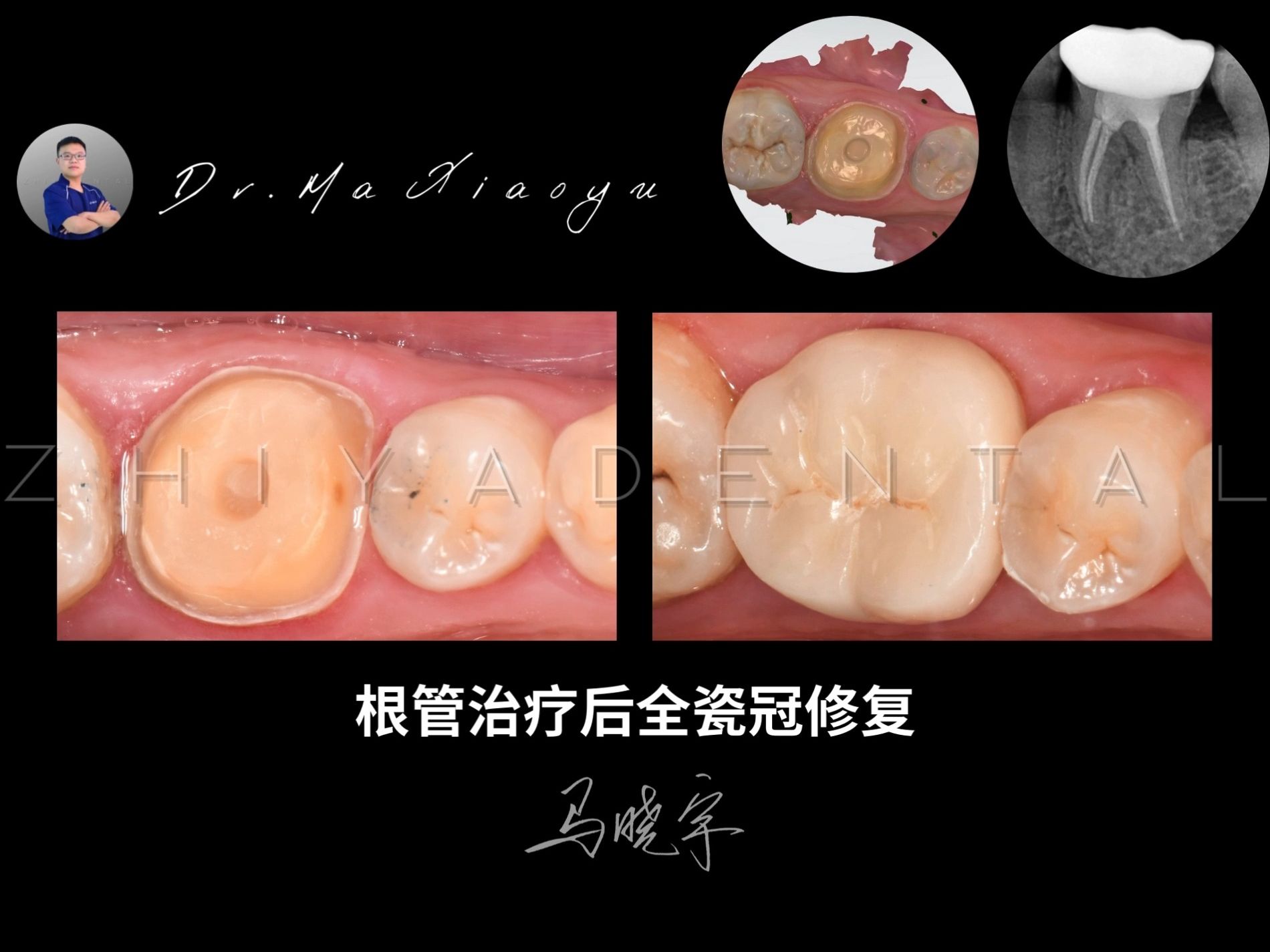 根管治疗牙套什么样子图片