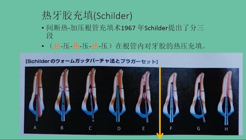赵奇老师的根管充填的要点讨论——根管治疗中遇到的10类问题哔哩哔哩bilibili