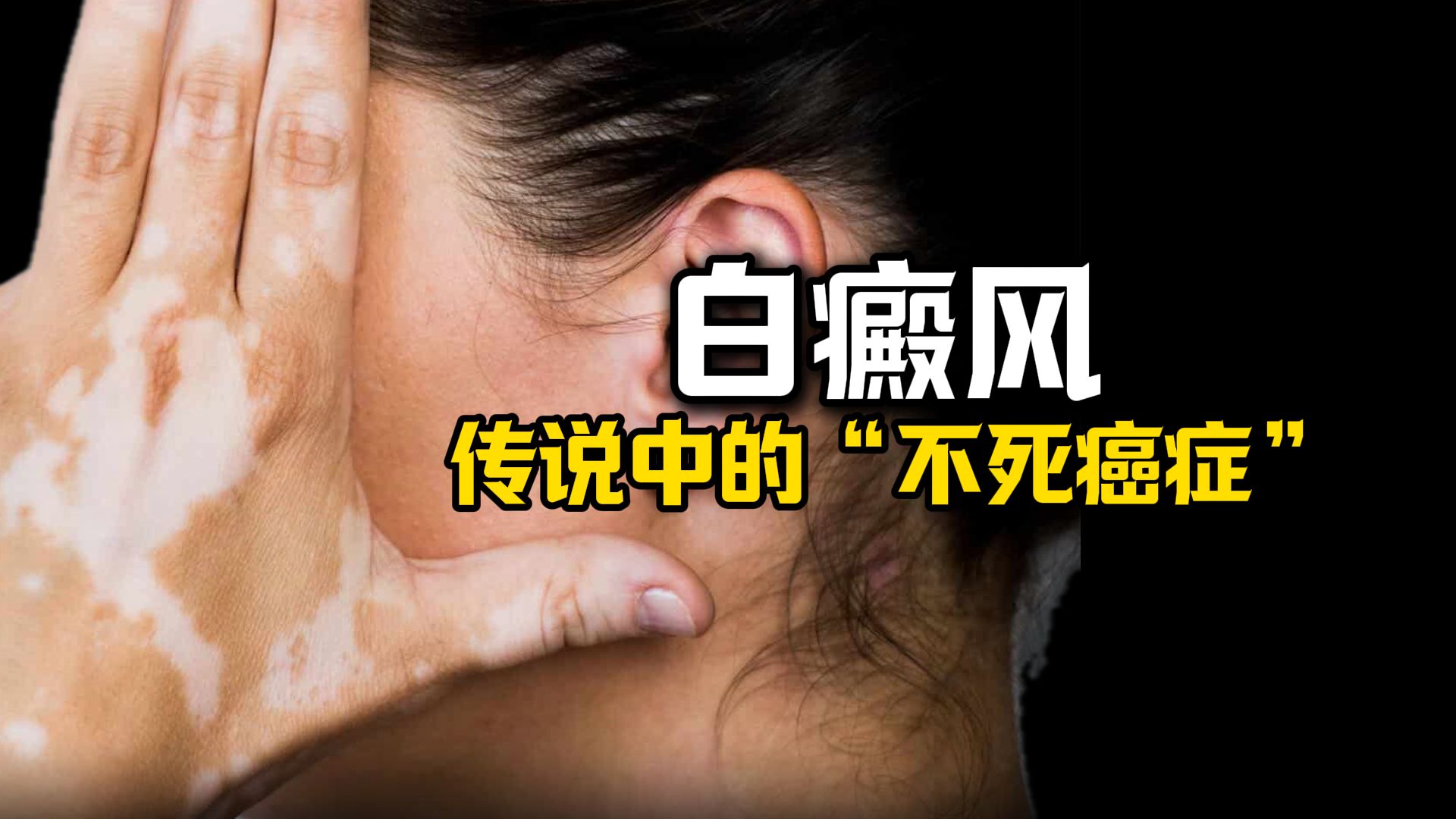 他是传说中的“不死癌症”白癜风