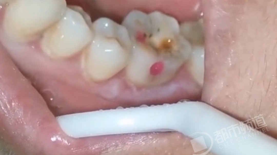 疼了一夜的牙齿，钻开后脓血溢出，网友：听到这个声音就力竭了