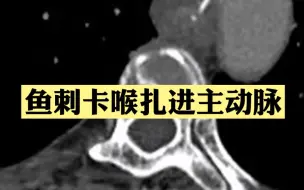 Скачать видео: 危险！女子硬吞饭团把鱼刺扎进主动脉