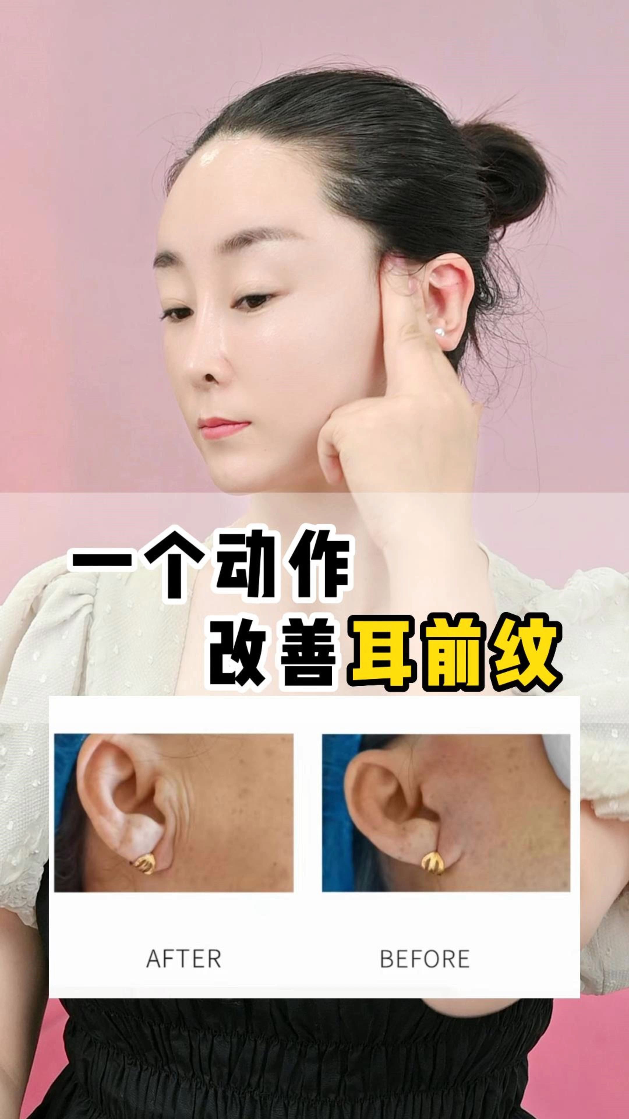 耳前有纹,怎么办?