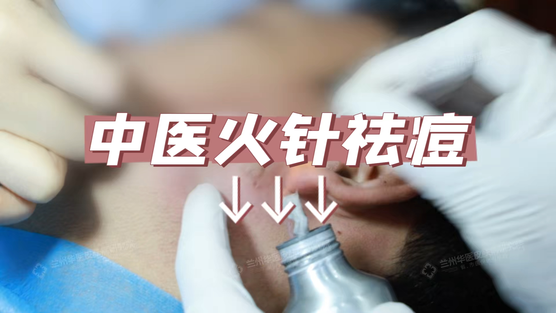 听说,痤疮和火针更配哦~兰州华医皮肤病研究院