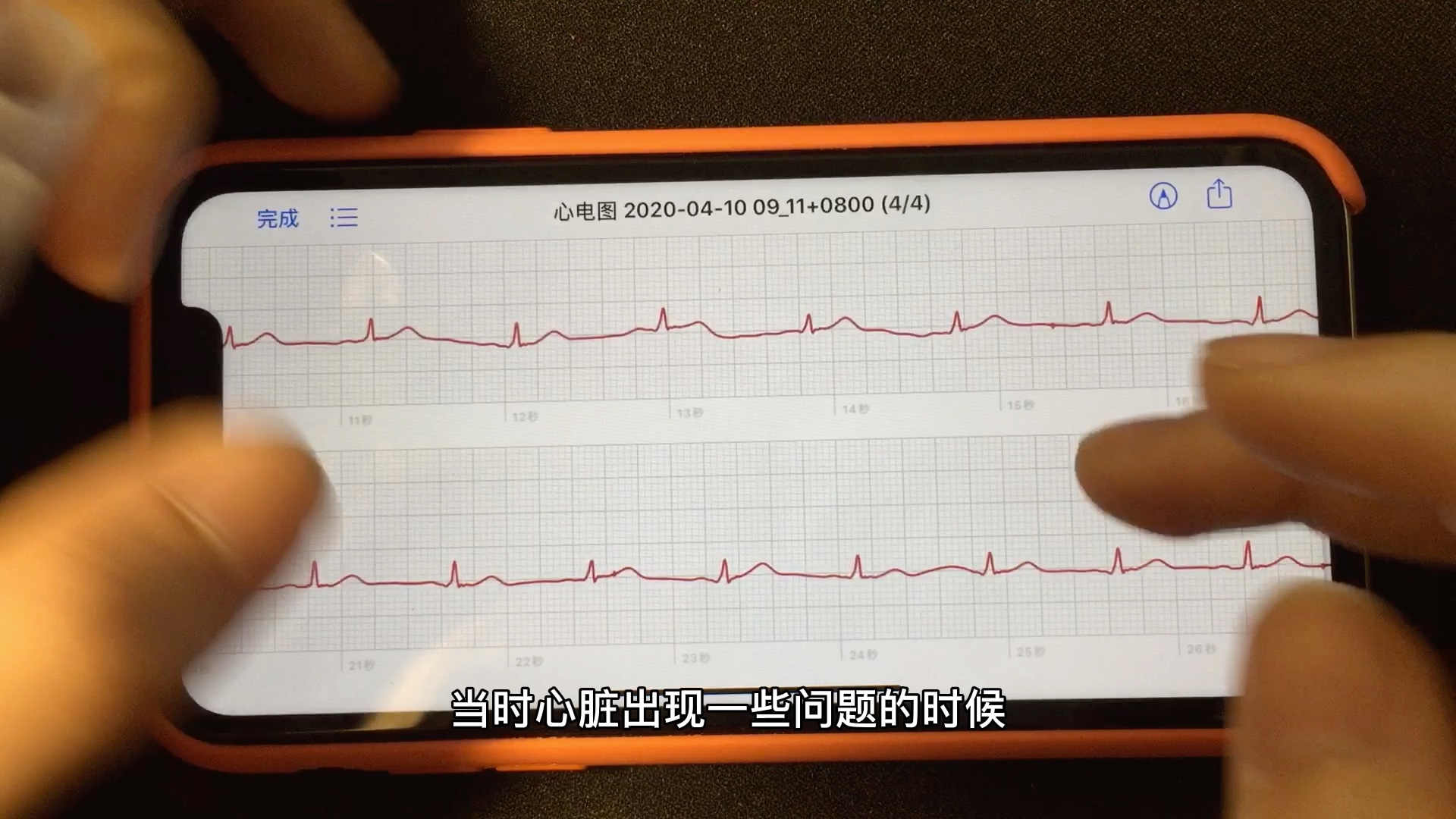 [图]临床医生体验讲解Apple Watch心电图功能