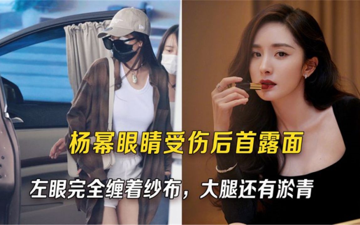 杨幂眼睛受伤后首次露面,左眼完全缠着纱布,大腿还有淤青