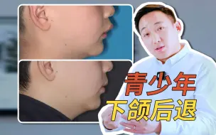 Descargar video: 颜面管理，儿童换牙期的下颌后退+超大深覆盖的早期矫正