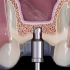 【深圳种植牙科普】上颌窦内提升是怎样的呢？