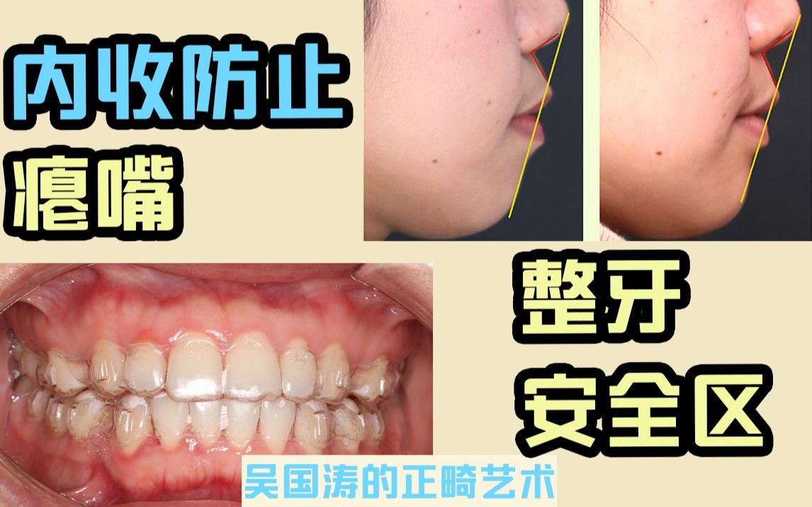 合肥隐形矫正|内收防止瘪嘴,要在安全区稳稳变美_哔哩哔哩_bilibili