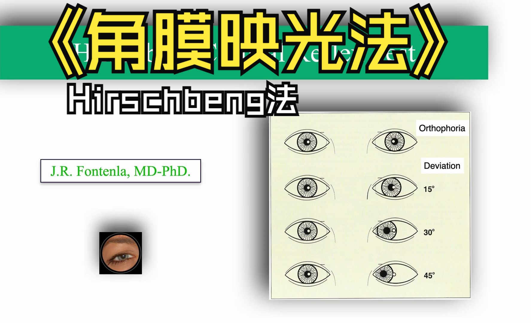 【中英双字】【角膜映光法测量斜视度数】hirschberg corneal reflex