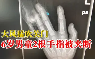 Скачать видео: 大风猛吹关门6岁男童手指被夹断：就连着点皮，4小时手术接指