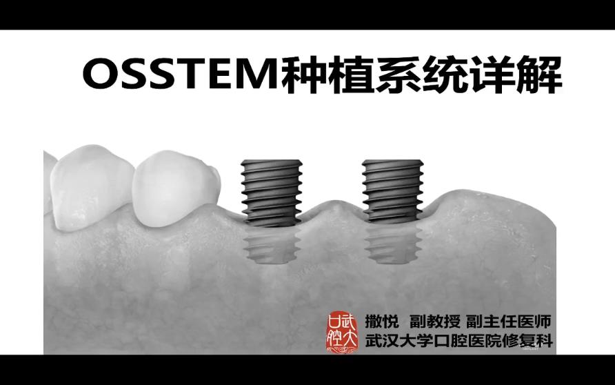 05第五节:常用种植系统详解3Osstem系统哔哩哔哩bilibili