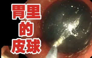 Descargar video: 【医学柯南】男子吃下一个黑色皮球，取不出来怎么办？ 扎破拿出来！？