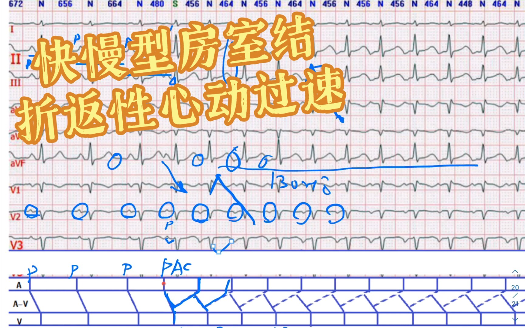 窦性心律,房早,快慢型房室结折返性心动过速,双房异常哔哩哔哩bilibili
