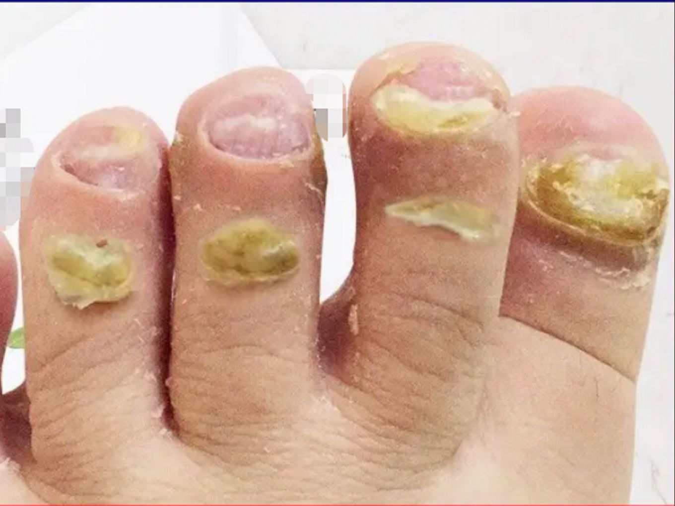 5年顽固灰指甲就这样被治好了?在家就能做,完全不用去医院!