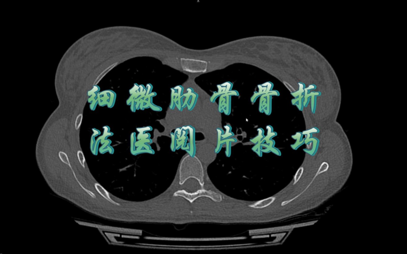 细微肋骨骨折法医鉴定阅片哔哩哔哩bilibili