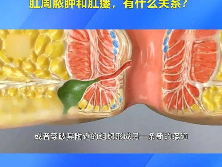 肛瘘瘘管位置图片