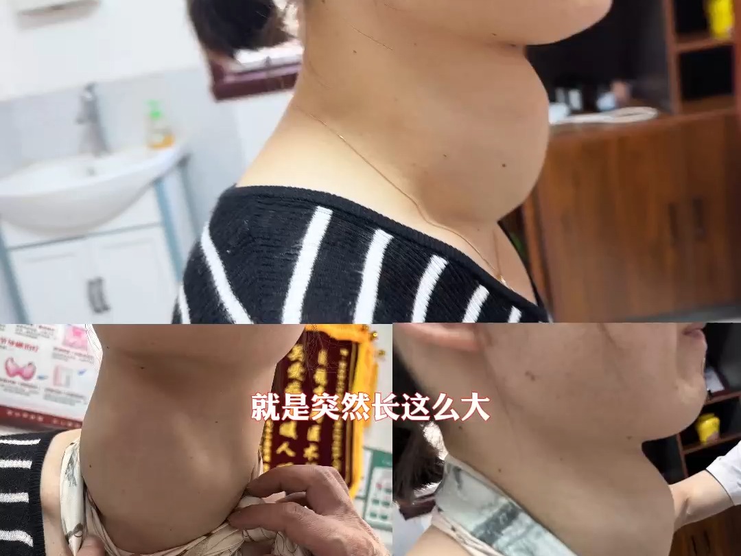 甲状腺结节手术做的最好的医院-甲康医院【渭南】桥本炎症 结节,脖子