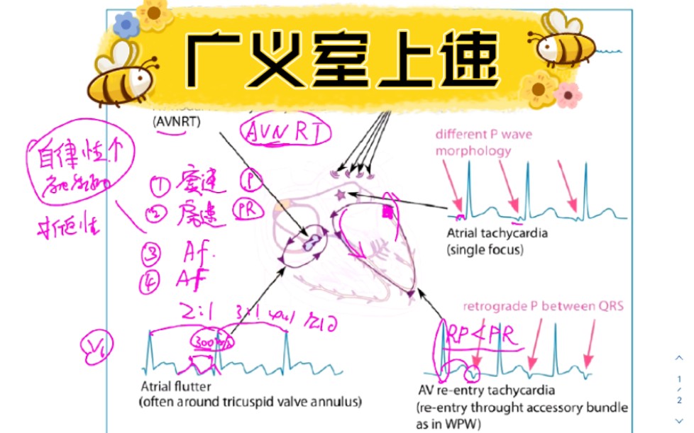 广义的室上性心动过速(室上速)是指起源于希氏束以上的心动过速,其机制大多为折返,少数由自律性增高或触发活动引起;可发生于窦房结、心房、房室...