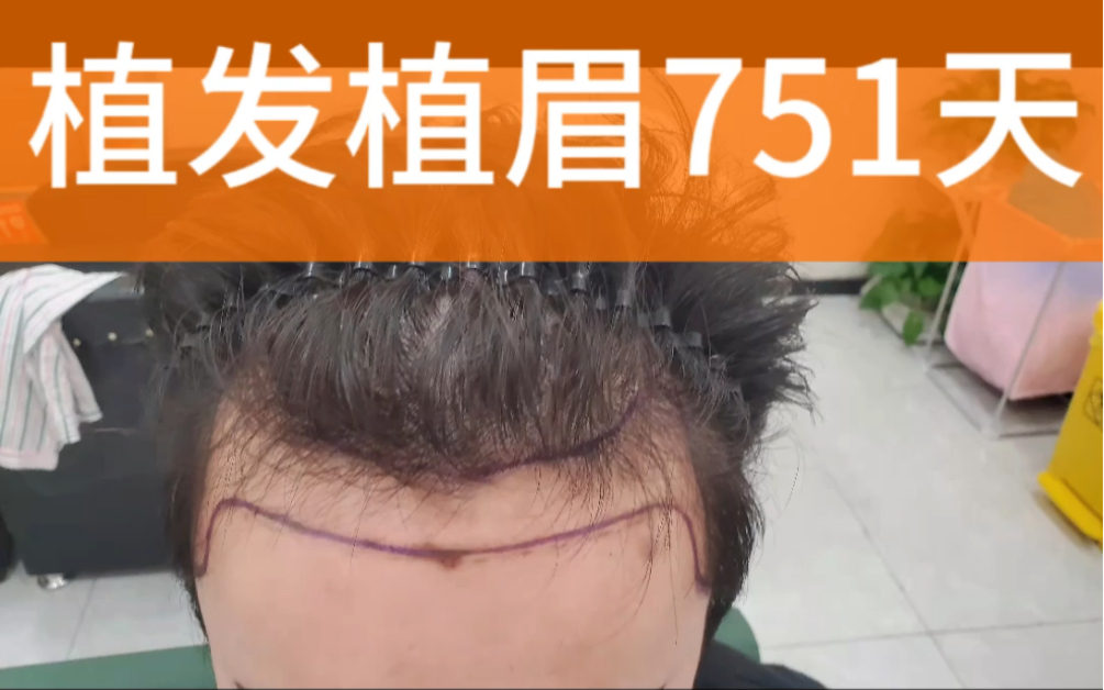 植眉植发2小时(植眉植发可以一起做吗)