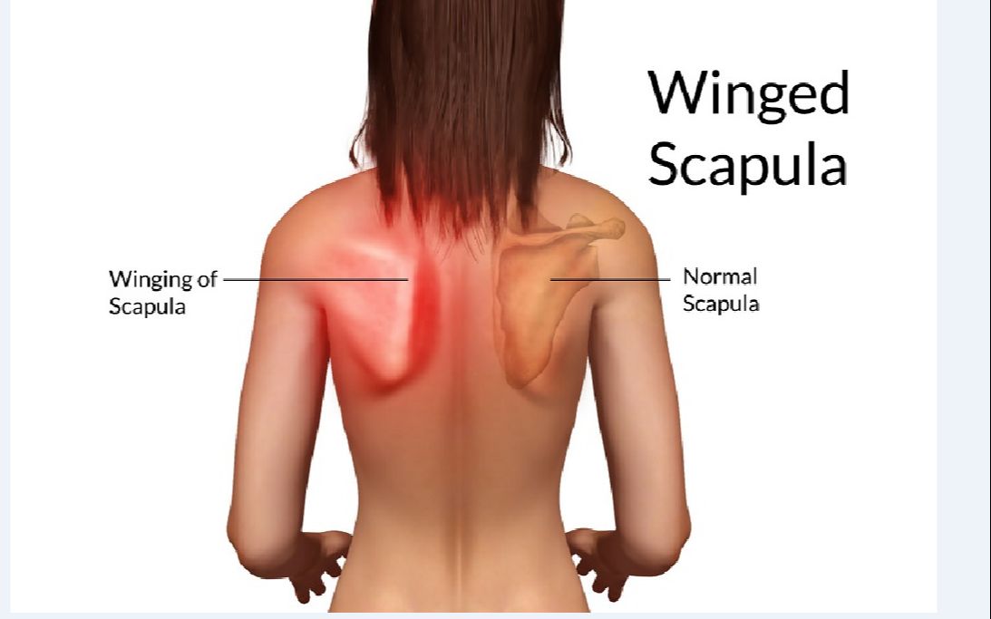 [图]一般人都有的【 肩胛骨外翻】的 解决方案 （菱形肌/肩甲提肌/背阔肌胸小肌/肩甲下肌 拉伸 + 前锯肌 加强练习）