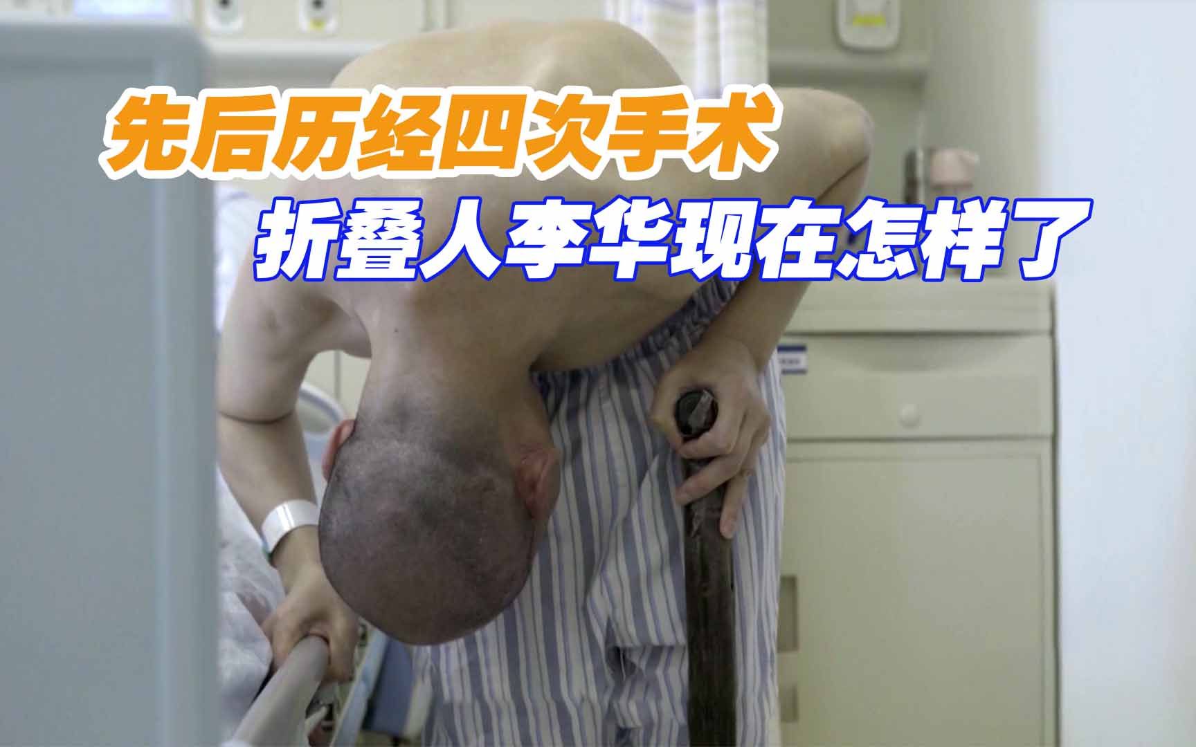 身体弯曲180度,历经四次手术后,“折叠人”李华现在怎么样了?哔哩哔哩bilibili