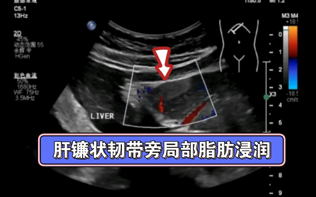 [图]镰旁局部特殊血供及周围的细小静脉因韧带牵拉、压迫发生闭塞时可引起周围肝脏缺血及缺氧，引起肝组织脂肪变性，所以镰旁肝质局部脂肪浸润的基础可能也是特殊血供所致。