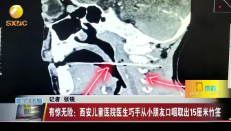 有惊无险：西安儿童医院医生巧手从小朋友口咽取出15厘米竹签