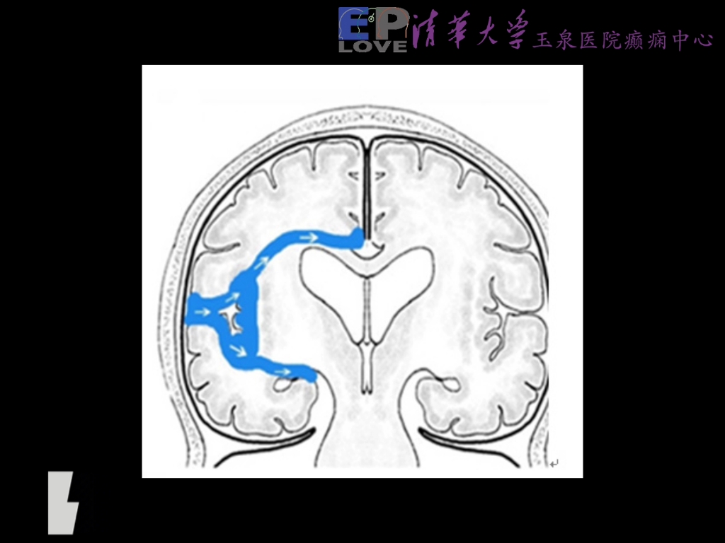 胼胝体离断与癫痫之一哔哩哔哩bilibili