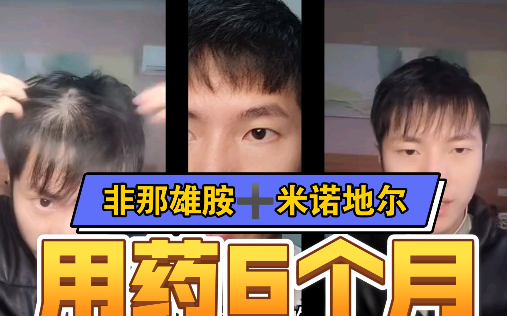 献上非那雄胺 米诺地尔6个月效果对比图!