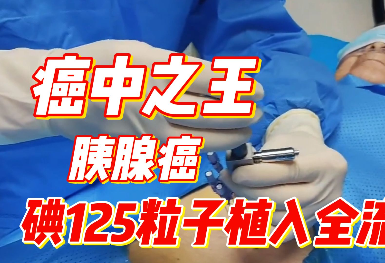 88岁老人身患胰腺癌,40颗碘125粒子植入,从内部爆破癌中之王哔哩哔哩bilibili