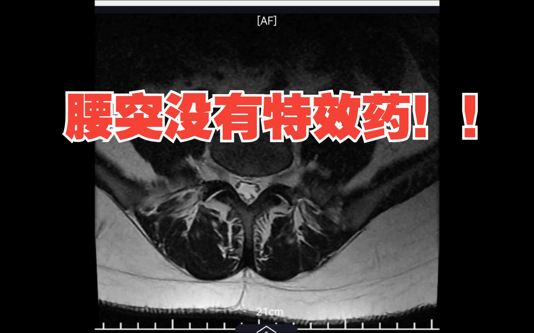 [图]腰突没有特效药（补发）