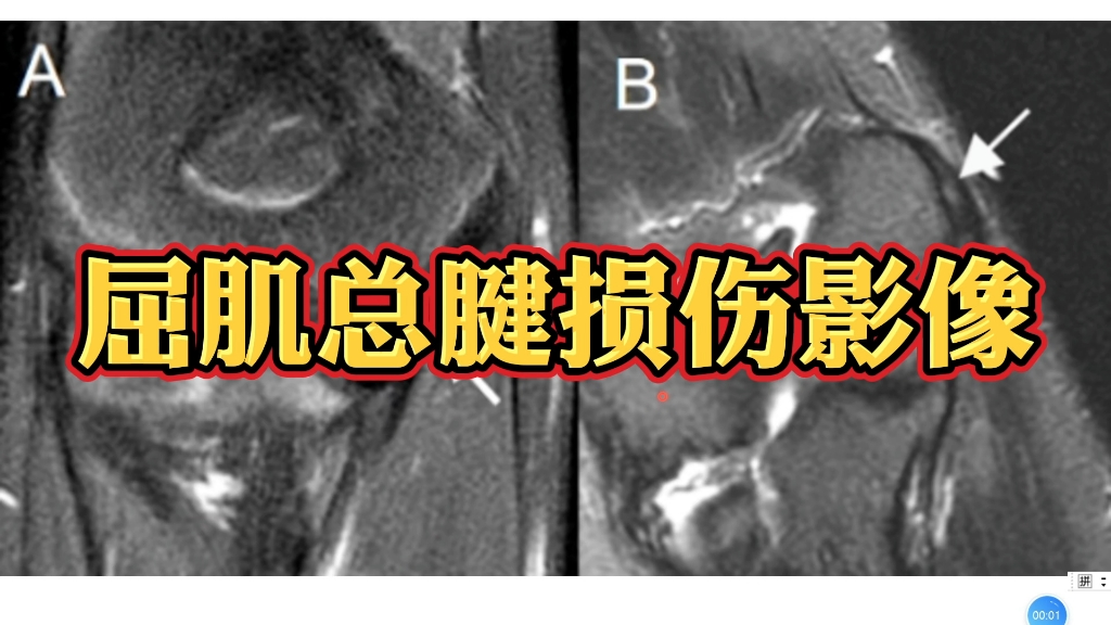 拇长屈肌腱解剖图mri图片