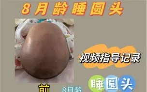 Video herunterladen: 8月龄大月龄不费妈快速睡圆头、头型矫正