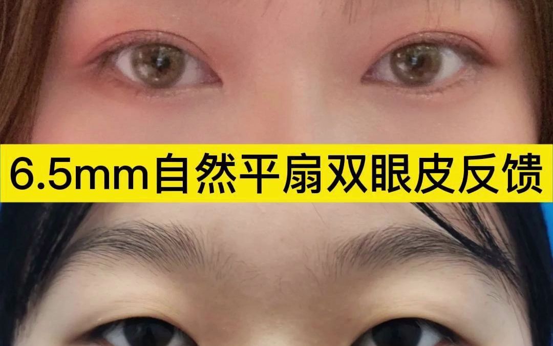 全切自然平扇形雙眼皮3個月,妥妥的自然媽生眼.