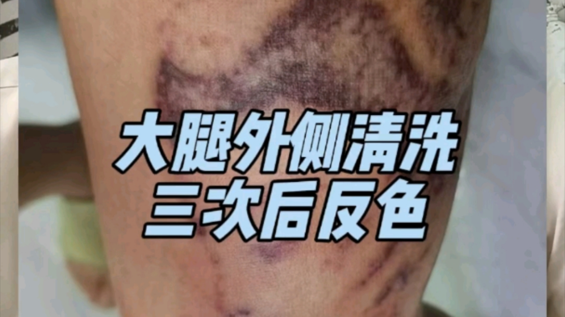 大腿清洗纹身反色记录对比